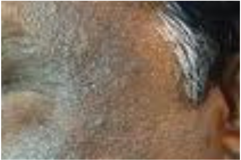 Acanthosis is a serious problem these days Acanthosis Negaricus is curable