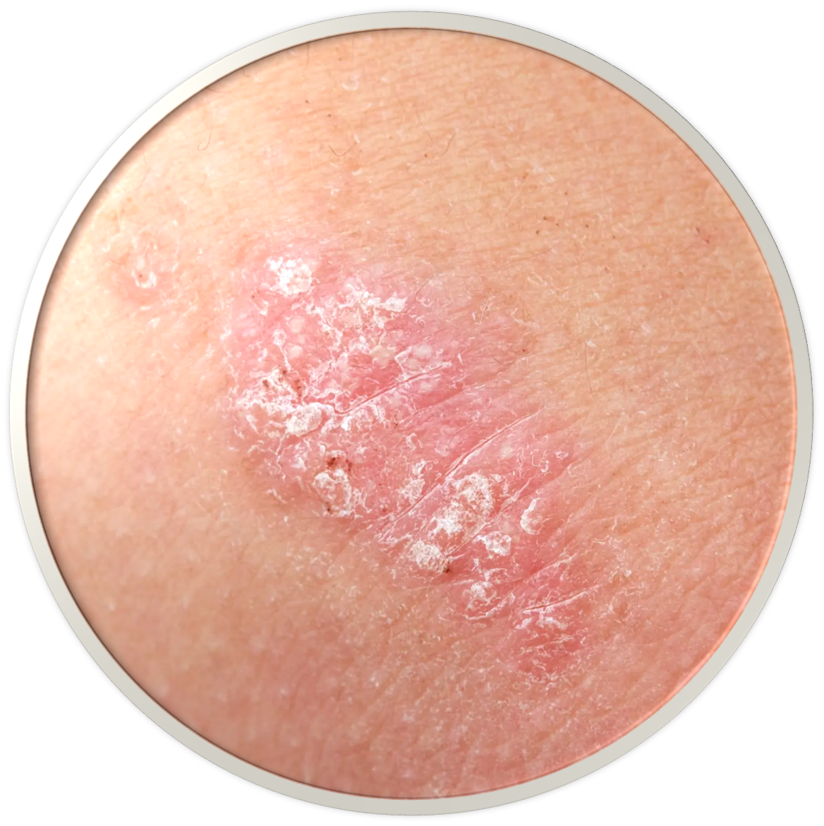 Psoriasis